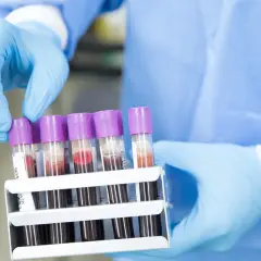 Ręce w niebieskich rękawiczkach trzymają stojak z probówkami krwi. Badanie poziomu estradiol co to jest?