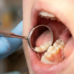 Dentysta bada zęby, szukając oznak próchnicy. Widoczne są zęby i lusterko dentystyczne.