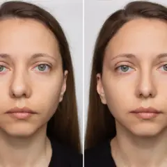Porównanie twarzy przed i po zabiegu septoplastyki. Widoczna subtelna zmiana w wyglądzie nosa.