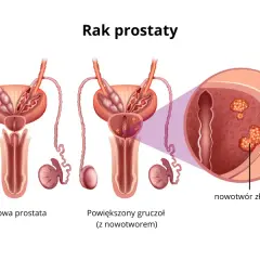 Czy rak prostaty daje przerzuty? Poznaj niebezpieczeństwa i objawy