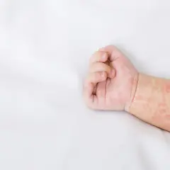 Dziecięca rączka z zaczerwienioną wysypką na skórze, widoczne drobne plamki.