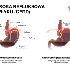 Ilustracja pokazuje prawidłowe i nieprawidłowe działanie zwieracza przełyku, wyjaśniając refluks i jego objawy.