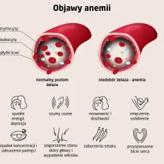 Anemia objawy: bladość skóry, spadek energii, szumy uszne, nerwowość, zmęczenie, bóle głowy, spadek koncentracji, pogorszenie stanu skóry i wypadanie włosów, zaburzenia smaku, przyspieszone bicie serca.