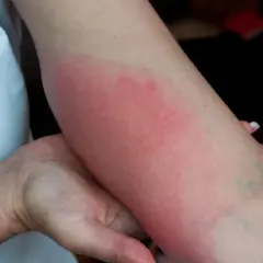 Rumień na ramieniu, objaw mogący wskazywać na neuroboreliozę.