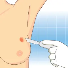 Ilustracja przedstawia biopsję gruboigłową piersi. Dłoń w rękawiczce trzyma skalpel, zbliżając się do podejrzanej zmiany na piersi.