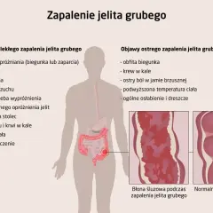 Zapalenie jelit objawy: biegunka, zaparcia, wzdęcia, bóle brzucha, krew w kale, gorączka, osłabienie. Ilustracja pokazuje zmiany w błonie śluzowej jelita.