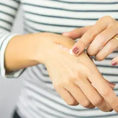 Dłoń z widoczną blizną, na którą aplikowana jest maść. Widoczna ziarnina w procesie gojenia.