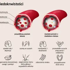 Niski poziom żelaza prowadzi do anemii, objawiającej się bladością, zmęczeniem, szumami w uszach, bólami głowy i innymi symptomami.