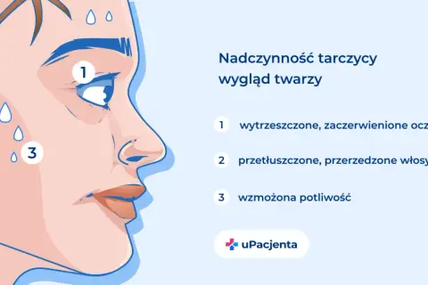 Nadczynność tarczycy objawy: wytrzeszczone oczy (1), przetłuszczone włosy (2), wzmożona potliwość (3).