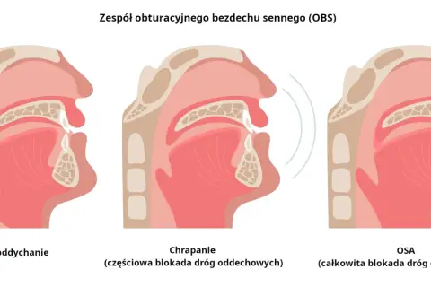 Ilustracja pokazuje przekrój dróg oddechowych przy normalnym oddychaniu, chrapaniu (częściowa blokada) i bezdechu sennym (całkowita blokada).
