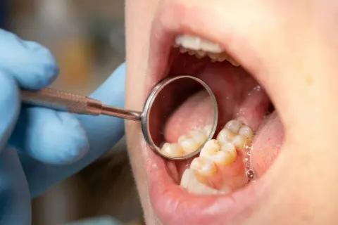 Dentysta bada zęby, szukając oznak próchnicy. Widoczne są zęby i lusterko dentystyczne.