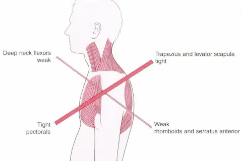 Anatomia mięśni: napięty mięsień czworoboczny, osłabione zginacze karku, napięte mięśnie piersiowe, osłabione mięśnie równoległoboczne i zębaty przedni.
