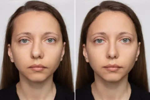 Porównanie twarzy przed i po zabiegu septoplastyki. Widoczna subtelna zmiana w wyglądzie nosa.