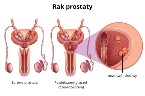 Czy rak prostaty daje przerzuty? Poznaj niebezpieczeństwa i objawy