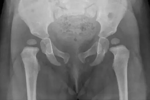 RTG miednicy dziecka z widoczną dysplazją stawu biodrowego, zniekształceniem panewek i głów kości udowych.