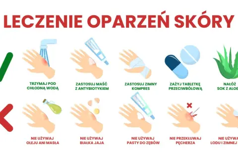 Ilustracja pokazuje leczenie oparzeń skóry: chłodna woda, maść z antybiotykiem, zimny kompres, tabletki przeciwbólowe, sok z aloesu. Unikaj masła, jajka, pasty do zębów, lodu.
