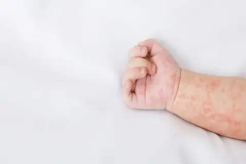 Dziecięca rączka z zaczerwienioną wysypką na skórze, widoczne drobne plamki.