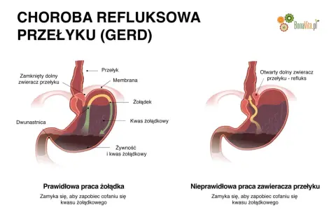 Ilustracja pokazuje prawidłowe i nieprawidłowe działanie zwieracza przełyku, wyjaśniając refluks i jego objawy.