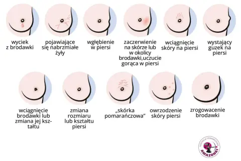 Ilustracja pokazuje różne zmiany w piersiach, w tym wyciek z brodawki, zaczerwienienie, wgłębienie, guzek, zmiany skórne i zrogowacenie. Ważne jest, by zwracać uwagę na sutki.
