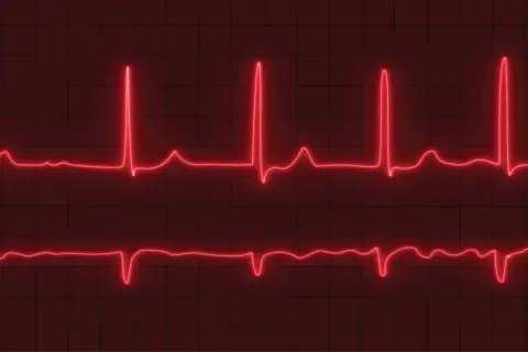 Dwa zapisy EKG na czerwonym tle. Górny zapis pokazuje szybkie, regularne skoki, sugerujące tachykardię zatokową. Dolny zapis jest wolniejszy.