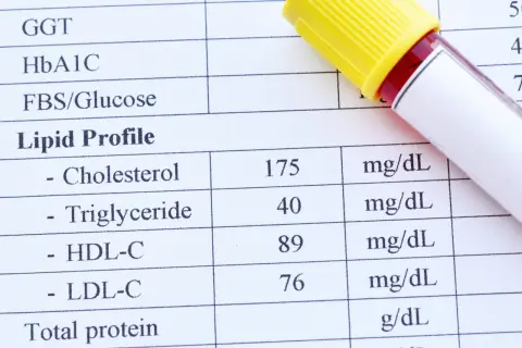 Wyniki lipidogramu: cholesterol 175, trójglicerydy 40, HDL-C 89, LDL-C 76 mg/dL. To ważne badanie, by sprawdzić lipidogram co to znaczy dla zdrowia.