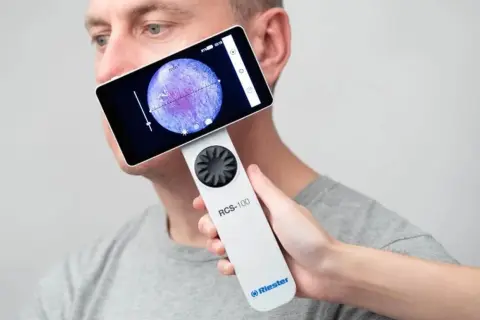 Badanie skóry twarzy za pomocą wideodermatoskopu. Urządzenie RCS-100 pozwala na szczegółową analizę zmian skórnych.