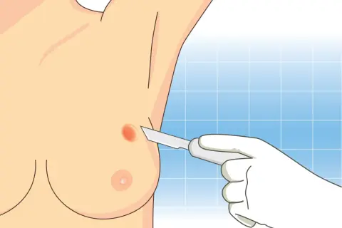 Ilustracja przedstawia biopsję gruboigłową piersi. Dłoń w rękawiczce trzyma skalpel, zbliżając się do podejrzanej zmiany na piersi.