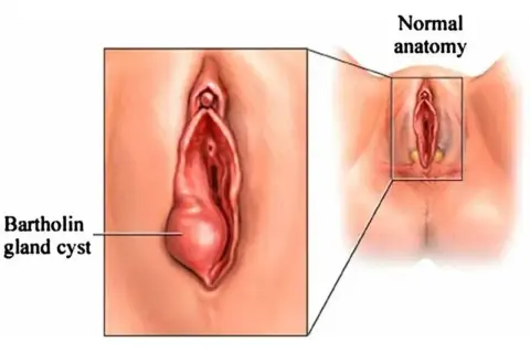 Ilustracja pokazuje powiększony gruczoł Bartholina z torbielą, w porównaniu do normalnej anatomii.