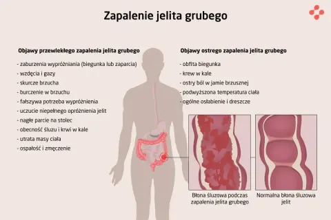 Zapalenie jelit objawy: biegunka, zaparcia, wzdęcia, bóle brzucha, krew w kale, gorączka, osłabienie. Ilustracja pokazuje zmiany w błonie śluzowej jelita.