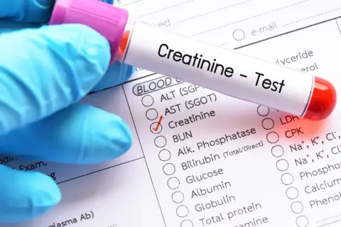 Rękawiczka w niebieskiej rękawiczce trzyma probówkę z napisem "Creatinine - Test". Obok zaznaczono "Creatinine", co sugeruje badanie poziomu kreatyniny w celu sprawdzenia, czy mieści się w kreatynina norma.