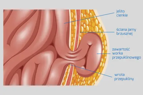 Ilustracja przedstawia przepuklinę pachwinową u mężczyzn, pokazując jelito cienkie przechodzące przez ścianę jamy brzusznej.