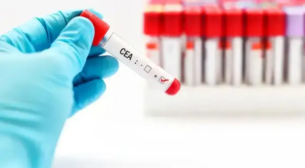 Ręka w niebieskiej rękawiczce trzyma probówkę z oznaczeniem CEA, gdzie zaznaczono wynik dodatni. W tle widać rząd innych probówek.