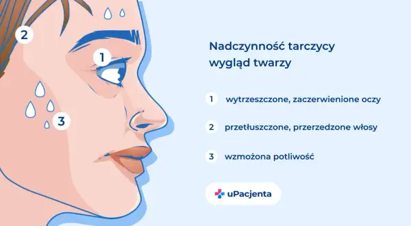 Nadczynność tarczycy objawy: wytrzeszczone oczy (1), przetłuszczone włosy (2), wzmożona potliwość (3).