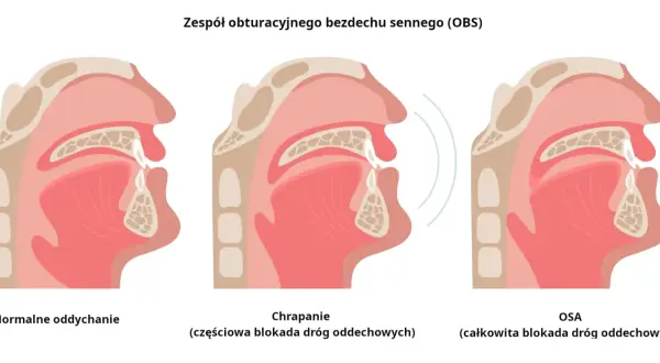Ilustracja pokazuje przekrój dróg oddechowych przy normalnym oddychaniu, chrapaniu (częściowa blokada) i bezdechu sennym (całkowita blokada).