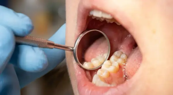 Dentysta bada zęby, szukając oznak próchnicy. Widoczne są zęby i lusterko dentystyczne.