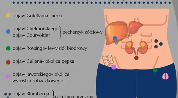 Objaw Jaworskiego, wskazujący na zapalenie wyrostka robaczkowego, zaznaczony jest na grafice w okolicy wyrostka.