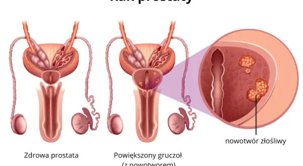 Czy rak prostaty daje przerzuty? Poznaj niebezpieczeństwa i objawy
