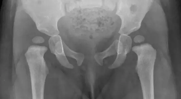 RTG miednicy dziecka z widoczną dysplazją stawu biodrowego, zniekształceniem panewek i głów kości udowych.
