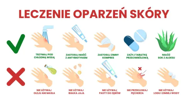 Ilustracja pokazuje leczenie oparzeń skóry: chłodna woda, maść z antybiotykiem, zimny kompres, tabletki przeciwbólowe, sok z aloesu. Unikaj masła, jajka, pasty do zębów, lodu.