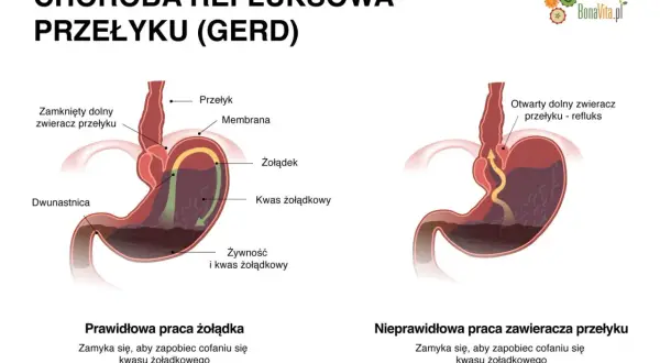 Ilustracja pokazuje prawidłowe i nieprawidłowe działanie zwieracza przełyku, wyjaśniając refluks i jego objawy.