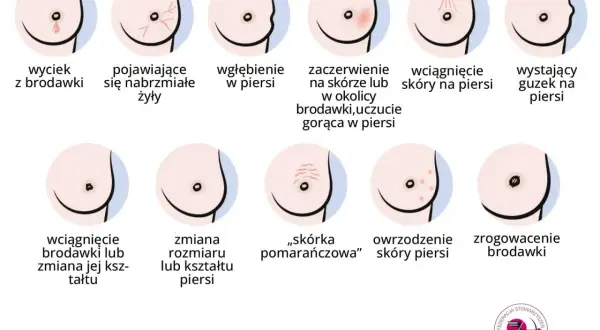 Ilustracja pokazuje różne zmiany w piersiach, w tym wyciek z brodawki, zaczerwienienie, wgłębienie, guzek, zmiany skórne i zrogowacenie. Ważne jest, by zwracać uwagę na sutki.