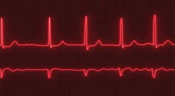 Dwa zapisy EKG na czerwonym tle. Górny zapis pokazuje szybkie, regularne skoki, sugerujące tachykardię zatokową. Dolny zapis jest wolniejszy.