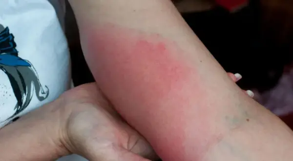 Rumień na ramieniu, objaw mogący wskazywać na neuroboreliozę.