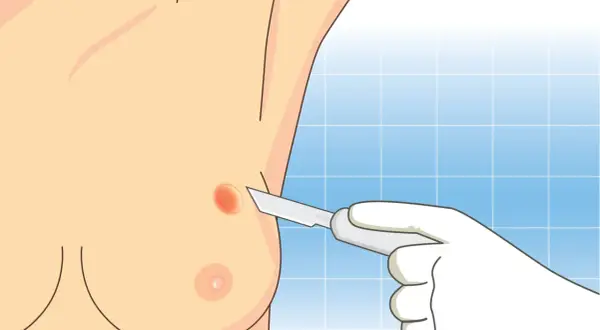Ilustracja przedstawia biopsję gruboigłową piersi. Dłoń w rękawiczce trzyma skalpel, zbliżając się do podejrzanej zmiany na piersi.