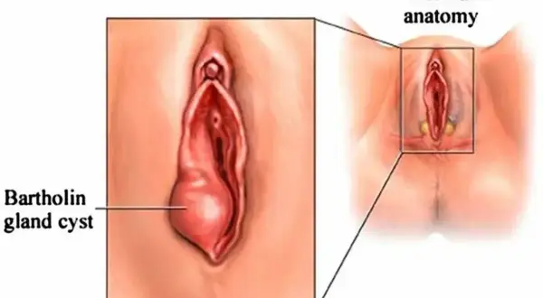 Ilustracja pokazuje powiększony gruczoł Bartholina z torbielą, w porównaniu do normalnej anatomii.