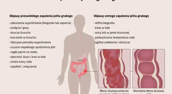 Zapalenie jelit objawy: biegunka, zaparcia, wzdęcia, bóle brzucha, krew w kale, gorączka, osłabienie. Ilustracja pokazuje zmiany w błonie śluzowej jelita.
