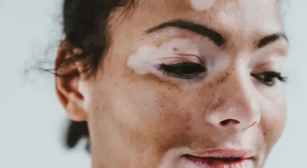 Portret kobiety z widocznym **vitiligo** na twarzy. Jasne plamy kontrastują z jej ciemniejszą skórą, tworząc unikalny wzór.