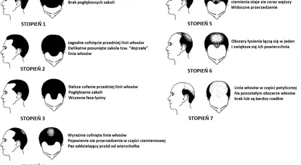 Ilustracja przedstawia 7 stopni łysienia androgenowego, od naturalnej linii włosów po całkowite wyłysienie.