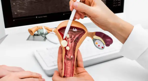Model macicy z widocznymi mięśniakami. Lekarz wskazuje na nie, omawiając diagnozę.