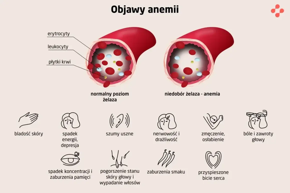 Anemia objawy: bladość skóry, spadek energii, szumy uszne, nerwowość, zmęczenie, bóle głowy, spadek koncentracji, pogorszenie stanu skóry i wypadanie włosów, zaburzenia smaku, przyspieszone bicie serca.